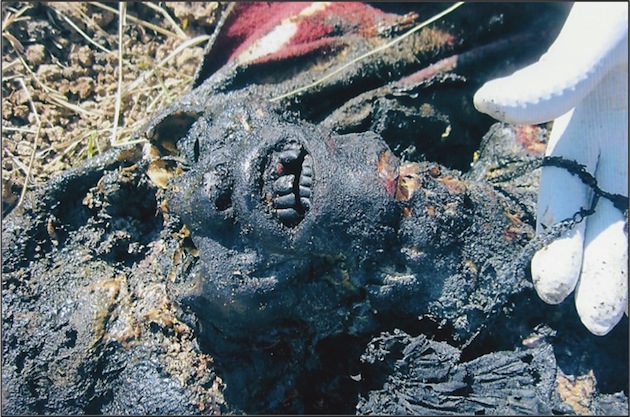Individual in Ukraine hit by a thermobaric weapon 3